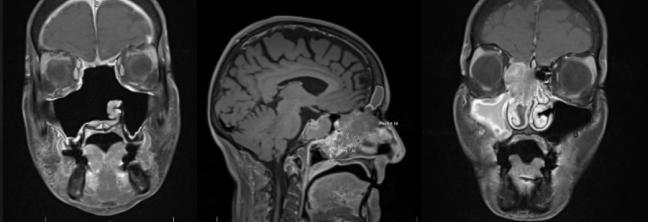 左嗅神经母细胞瘤切除前后的MRI